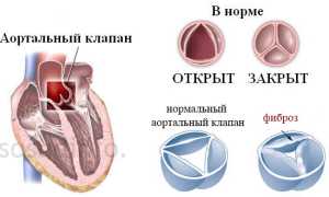 Фиброз клапанов сердца: причины, симптомы, диагностика, лечение, прогноз
