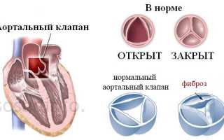 Фиброз клапанов сердца: причины, симптомы, диагностика, лечение, прогноз