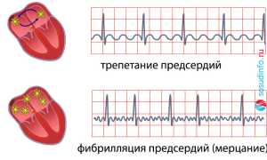 Трепетание предсердий: причины, формы, диагностика, лечение, прогноз
