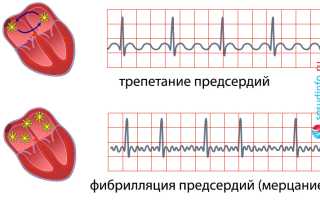 Трепетание предсердий: причины, формы, диагностика, лечение, прогноз