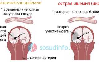 Ишемия: причины возникновения, формы, проявления и течение в различных органах, лечение, прогноз