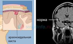 Киста головного мозга: разбор основных типов, их развитие, проявления, тактика