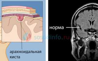 Киста головного мозга: разбор основных типов, их развитие, проявления, тактика