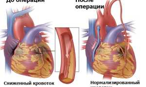 Реваскуляризация миокарда: цель, способы – традиционные и современные, как проводится