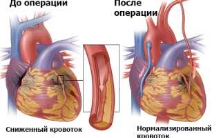 Реваскуляризация миокарда: цель, способы – традиционные и современные, как проводится
