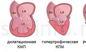 Кардиомиопатия различных видов: возникновение, диагностика и лечение болезни