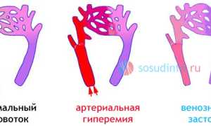 Гиперемия (полнокровие): причины, когда это болезнь, локализации, лечение