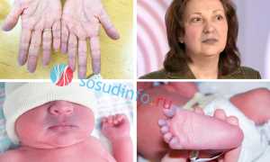 Цианоз: что это, причины, симптомы и формы, лечение