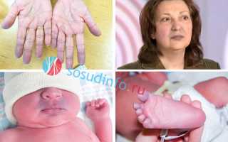 Цианоз: что это, причины, симптомы и формы, лечение