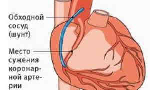 РЧ-абляция сердца: особенности, подготовка, процедура, восстановление после