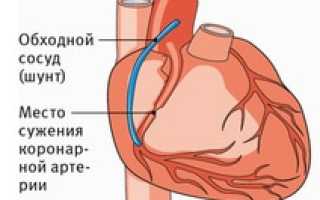 РЧ-абляция сердца: особенности, подготовка, процедура, восстановление после