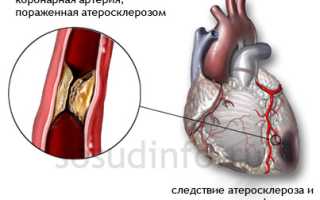 Острый коронарный синдром: причины, как развивается, проявления, диагностика, тактика лечения