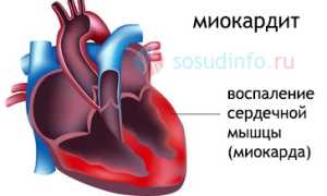 Миокардит: признаки, причины возникновения, формы, диагностика, терапия