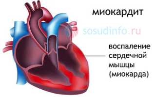 Миокардит: признаки, причины возникновения, формы, диагностика, терапия