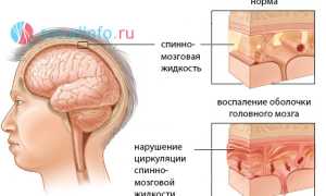 Ликворная киста: что это, как возникает, симптоматика и виды, диагностика, когда и как лечить?