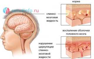 Ликворная киста: что это, как возникает, симптоматика и виды, диагностика, когда и как лечить?