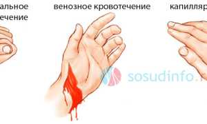 Повреждение сосудов: развитие, виды и диагностика, первая помощь и лечение