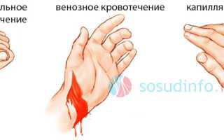 Повреждение сосудов: развитие, виды и диагностика, первая помощь и лечение