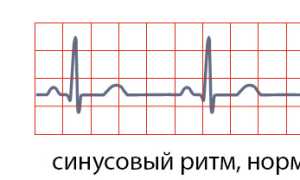 Нормосистолия, тахи- и бради-: понятие, как отражается на ЭКГ, норма и отклонения