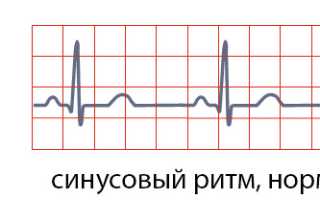 Нормосистолия, тахи- и бради-: понятие, как отражается на ЭКГ, норма и отклонения