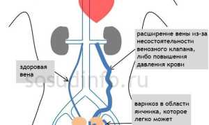 Варикозное расширение вен малого таза: при беременности, после и до