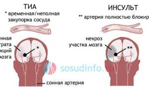 Шунтирование сосудов головы: как устраняют нарушение мозгового кровотока?