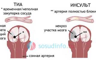 Шунтирование сосудов головы: как устраняют нарушение мозгового кровотока?