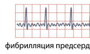 Фибрилляции: формы, признаки, причины, первая помощь и терапия