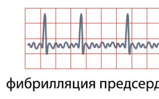 Фибрилляции: формы, признаки, причины, первая помощь и терапия