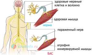 Боковой амиотрофический склероз: причины, признаки и течение, диагноз, как с ним жить?