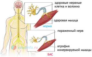 Боковой амиотрофический склероз: причины, признаки и течение, диагноз, как с ним жить?