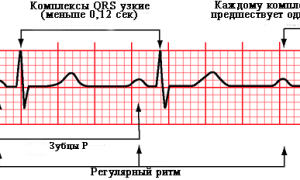 Синусовый ритм: суть, отражение на ЭКГ, норма и отклонения, особенности