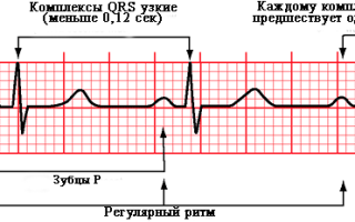 Синусовый ритм: суть, отражение на ЭКГ, норма и отклонения, особенности