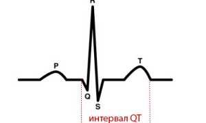 Интервал QT: понятие, норма, синдром удлиненного – его диагностика и лечение