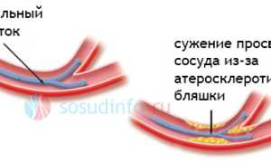 Атеросклеротическое сужение сосудов головы и шеи: возникновение, признаки, лечение