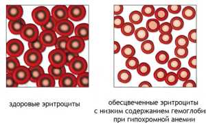 Цветовой показатель: расчет, норма у детей и взрослых, причины низкого и высокого