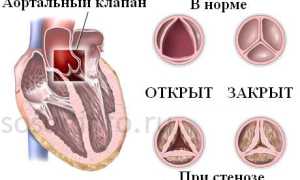 Кальциноз сердца и сосудов: возникновение, признаки, диагностика, лечение