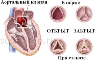 Кальциноз сердца и сосудов: возникновение, признаки, диагностика, лечение