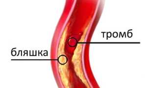 Закупорка сосудов: возникновение, основные локализации, признаки, как лечить, прогноз