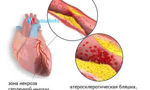 Трансмуральный инфаркт: понятие, проявления, признаки на ЭКГ, как лечить, прогноз