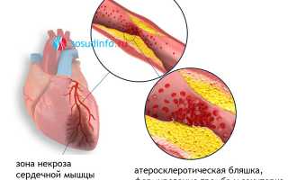 Трансмуральный инфаркт: понятие, проявления, признаки на ЭКГ, как лечить, прогноз