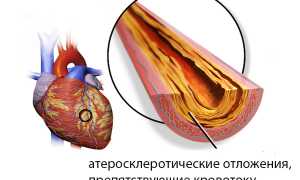 Диффузный кардиосклероз: как развивается, проявления, диагноз, как лечить, прогноз
