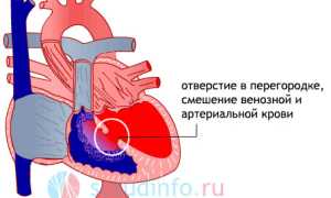Пороки сердца у детей и взрослых: суть, признаки, лечение, последствия