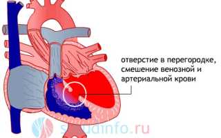 Пороки сердца у детей и взрослых: суть, признаки, лечение, последствия
