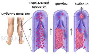 Эмболия легочной артерии: причины и развитие, признаки и течение, диагностика, терапия