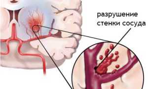 Геморрагический инсульт головного мозга: виды, симптомы, диагностика, лечение, факторы риска