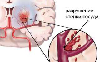 Геморрагический инсульт головного мозга: виды, симптомы, диагностика, лечение, факторы риска
