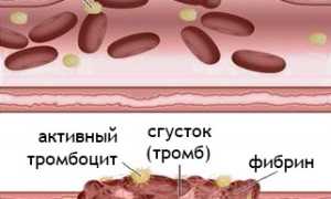 Болезнь Верльгофа: патогенез, симптомы, диагностика, лечение, профилактика