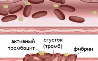 Болезнь Верльгофа: патогенез, симптомы, диагностика, лечение, профилактика