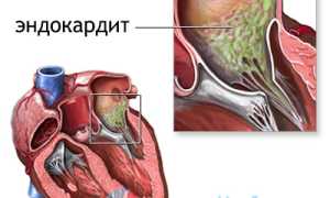 Эндокардит: причины и развитие, симптомы, диагностика, терапия различных видов